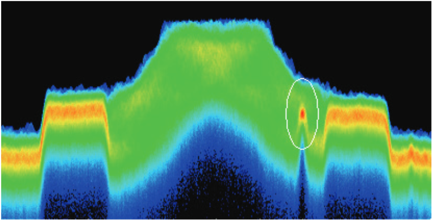 Circled signal shows a narrowband interference transmission buried in High Definition FM radio signal.